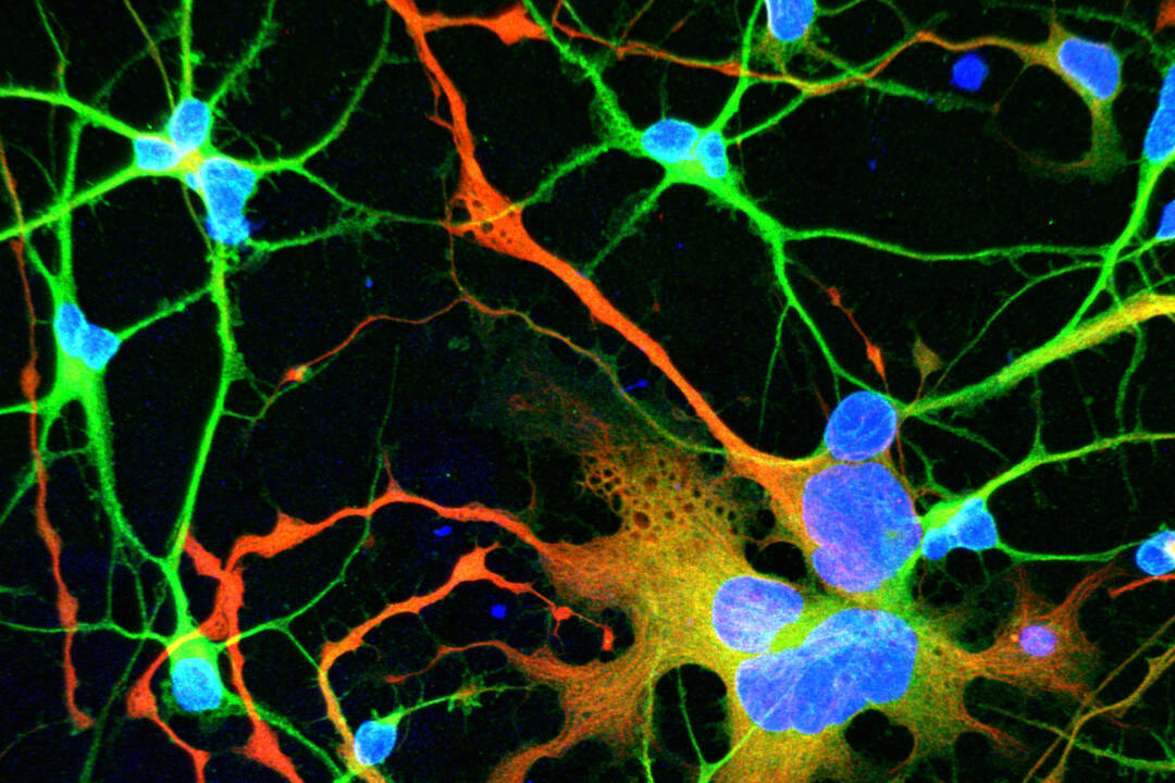 Huntington's pathology, Photo credit Gist Croft/Ali Brivanlou